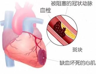 血栓的形成原因及后果，如何預防血栓導致的疾病